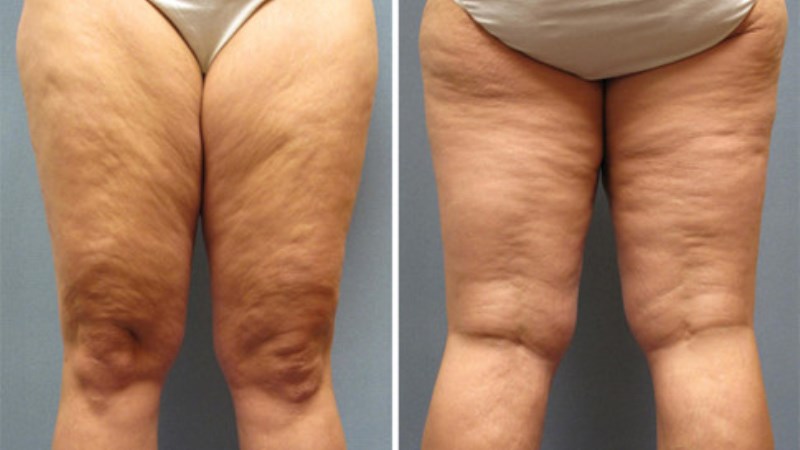 Causes Of Cellulite