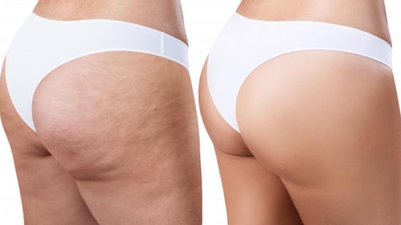 Cellulite Myths vs. Cellulite Facts