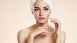 Hormone Imbalance Acne - Hormonal Acne Treatments and Cures