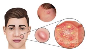 Nodular Acne Treatments - How To Get Rid of Nodule Acne